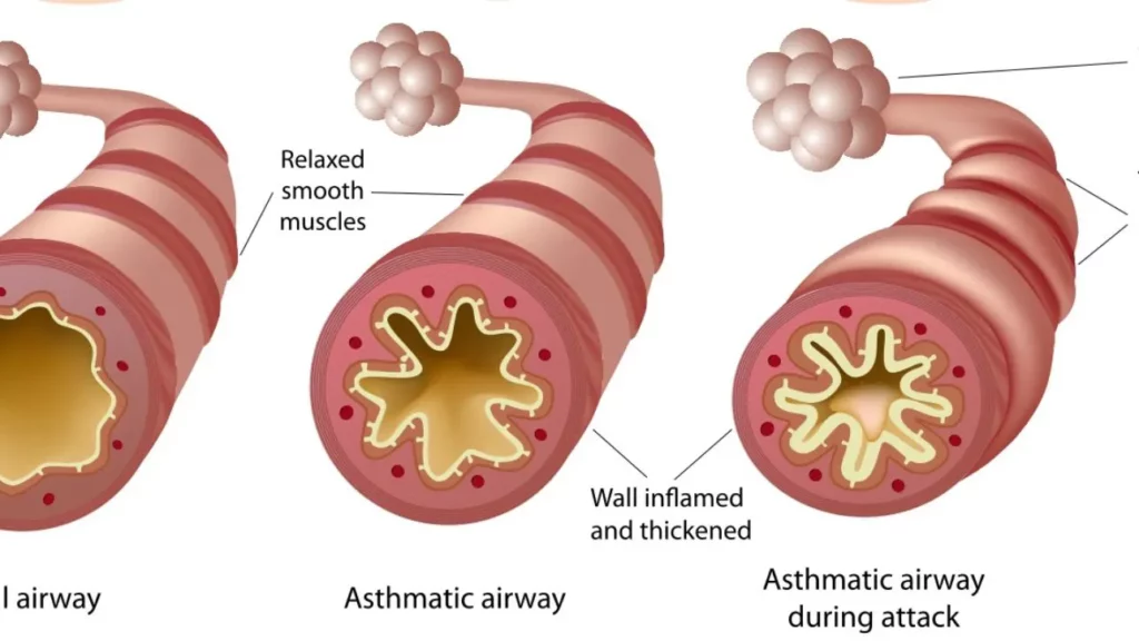 Asthmatic airway illustration