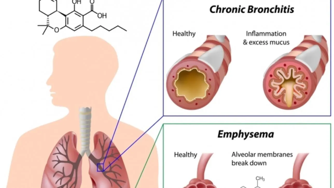 Cannabis and Chronic Obstructive Pulmonary Disease (COPD)